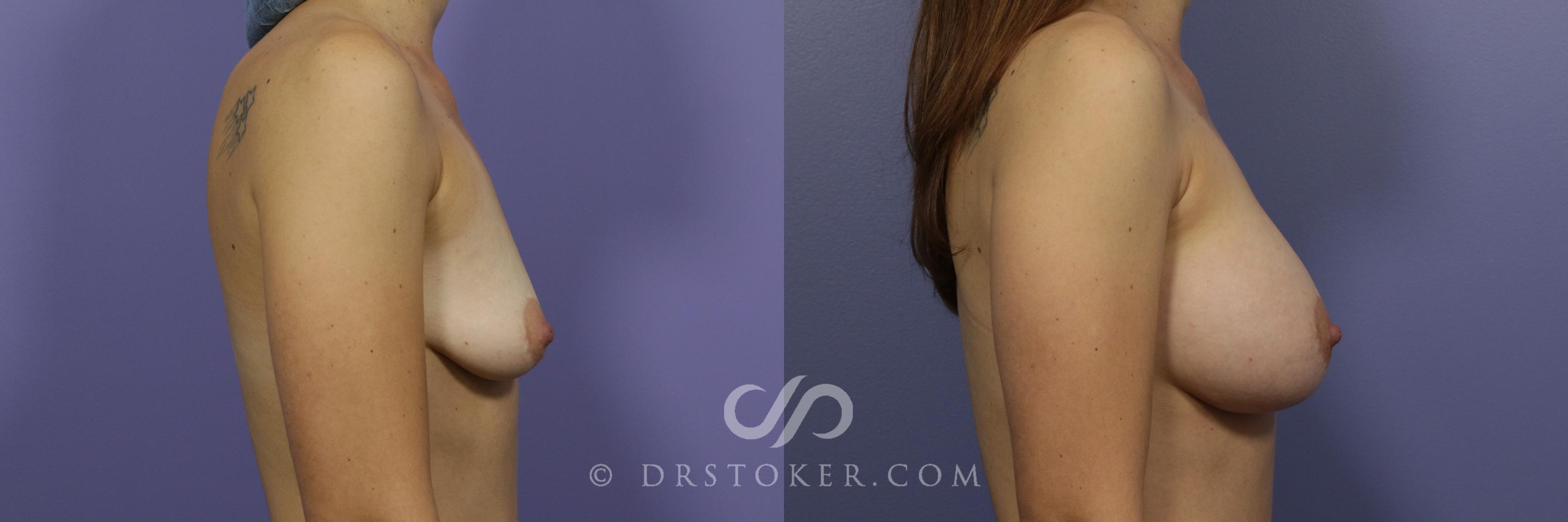 Before & After Breast Augmentation, Rapid Recovery Case 1059 View #3 View in Los Angeles, CA