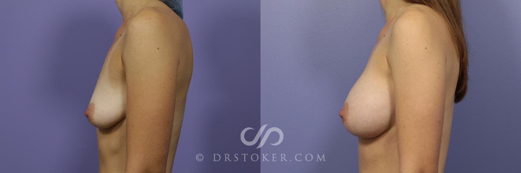 Before & After Breast Augmentation, Rapid Recovery Case 1059 View #5 View in Los Angeles, CA
