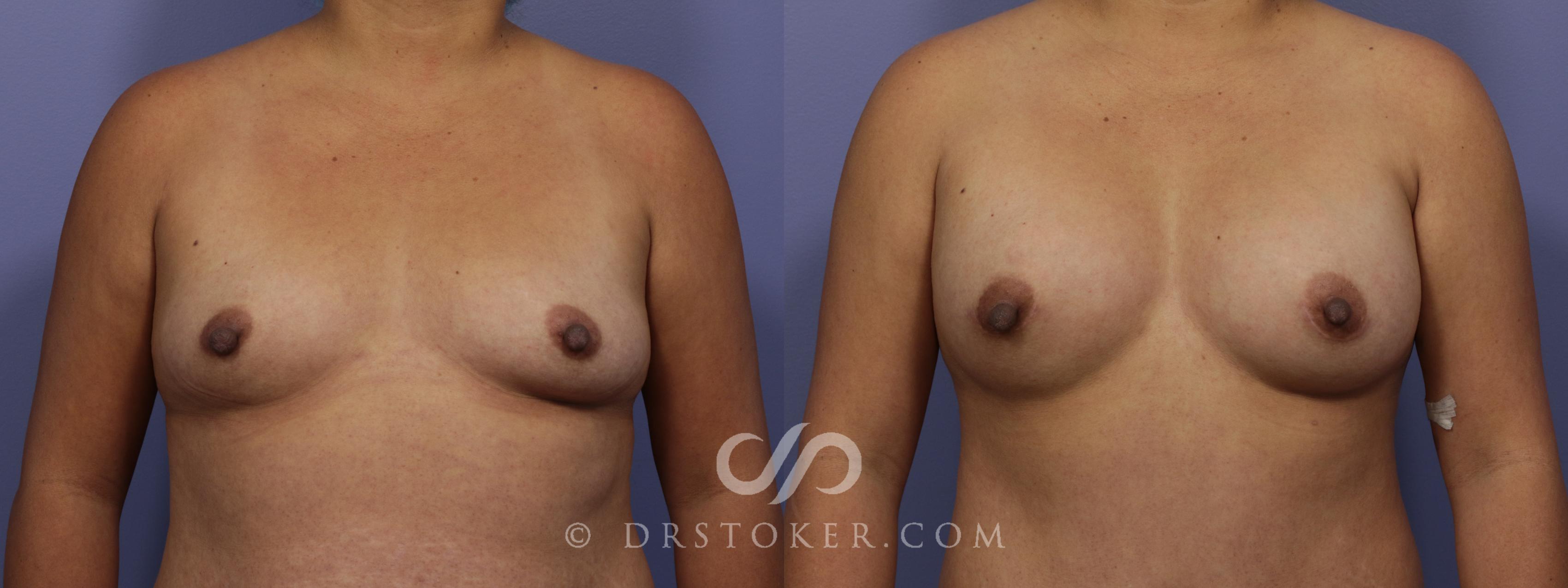 Before & After Breast Augmentation, Rapid Recovery Case 1060 View #1 View in Los Angeles, CA