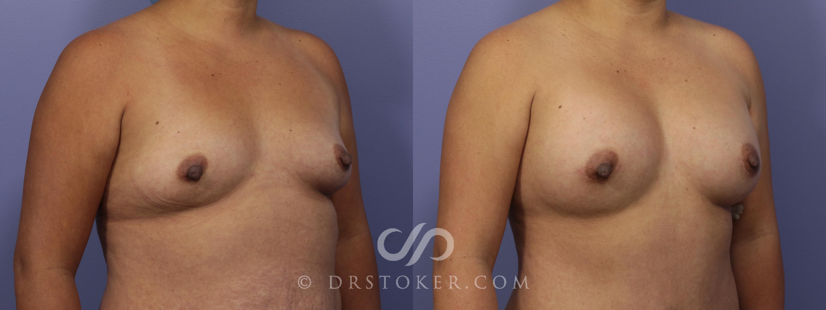 Before & After Breast Augmentation, Rapid Recovery Case 1060 View #2 View in Los Angeles, CA