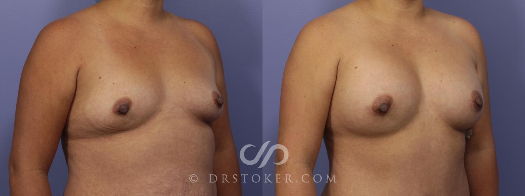 Before & After Breast Augmentation, Rapid Recovery Case 1060 View #2 View in Los Angeles, CA