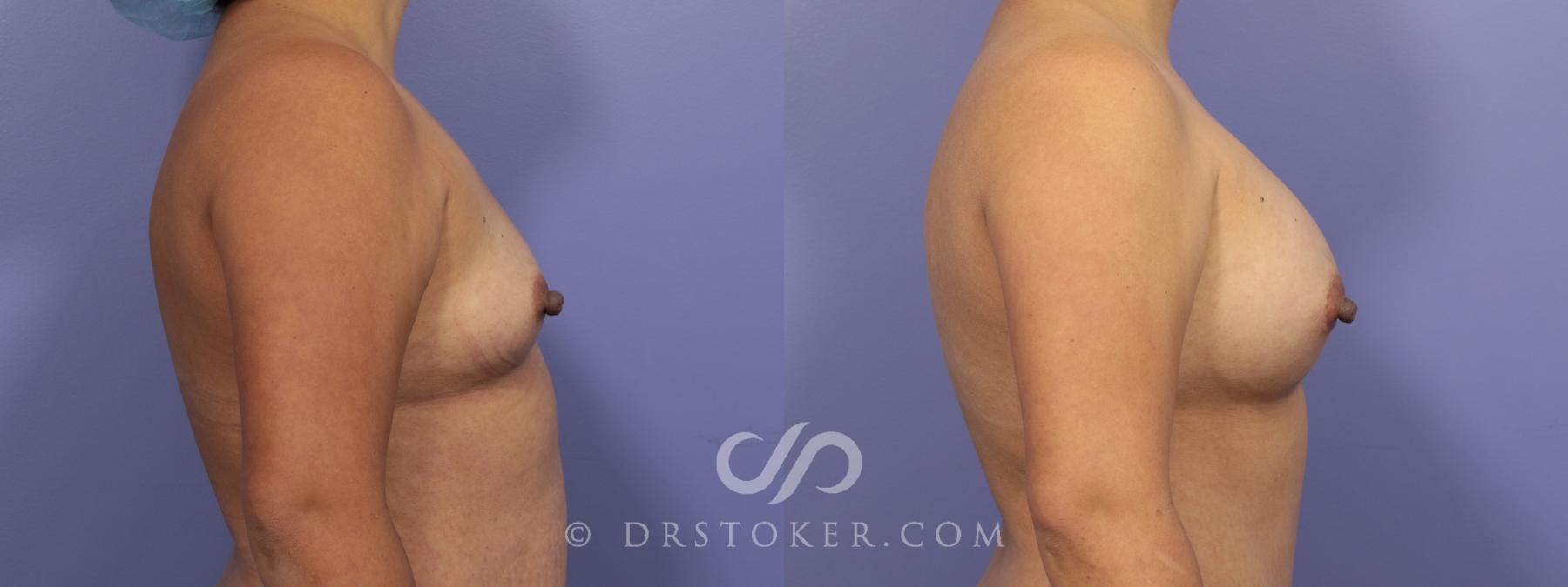 Before & After Breast Augmentation, Rapid Recovery Case 1060 View #3 View in Los Angeles, CA
