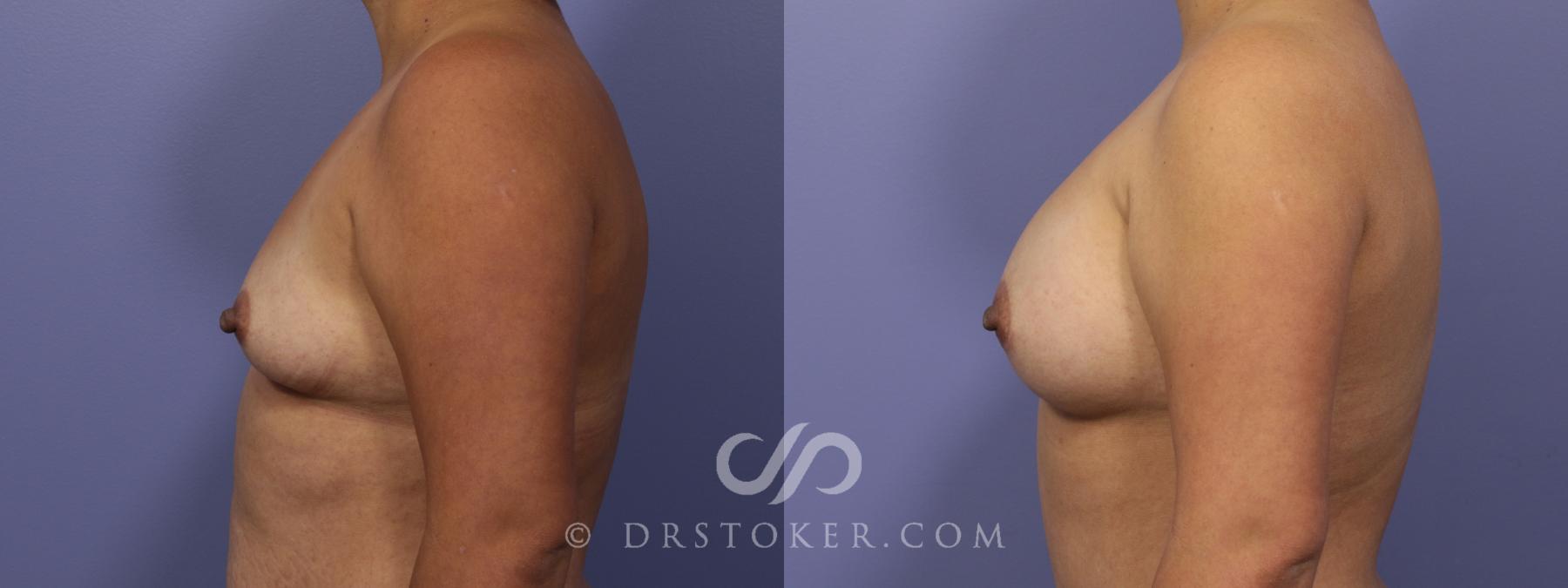 Before & After Breast Augmentation, Rapid Recovery Case 1060 View #4 View in Los Angeles, CA