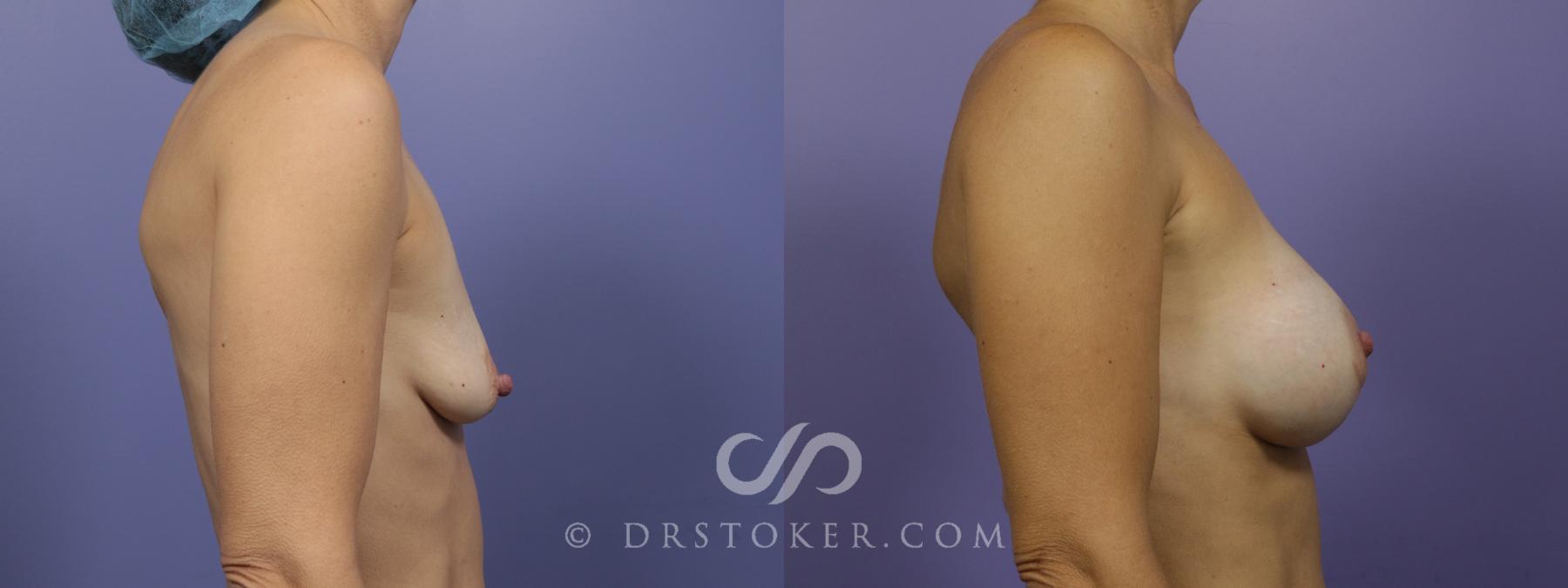Before & After Breast Augmentation, Rapid Recovery Case 1061 View #3 View in Los Angeles, CA