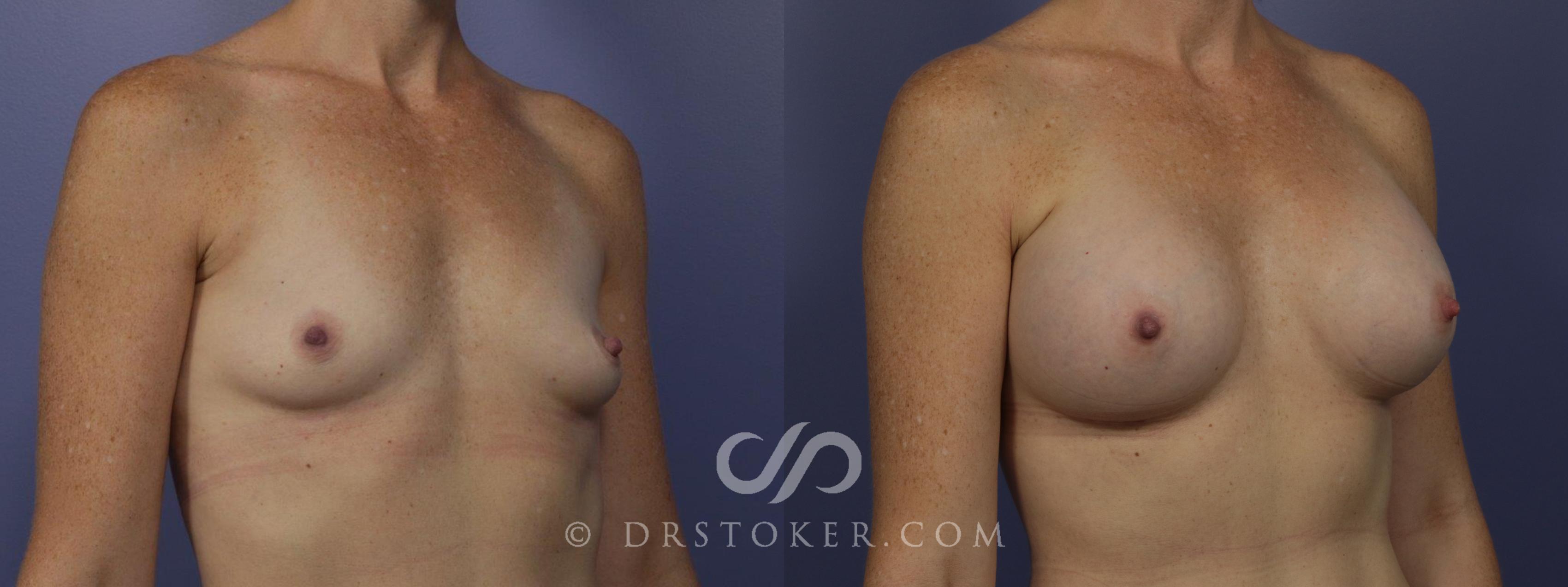 Before & After Breast Augmentation, Rapid Recovery Case 1062 View #2 View in Los Angeles, CA