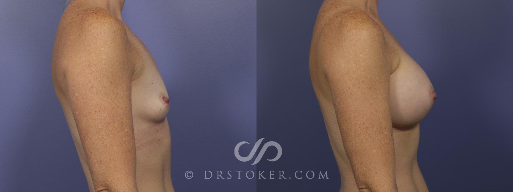 Before & After Breast Augmentation, Rapid Recovery Case 1062 View #3 View in Los Angeles, CA