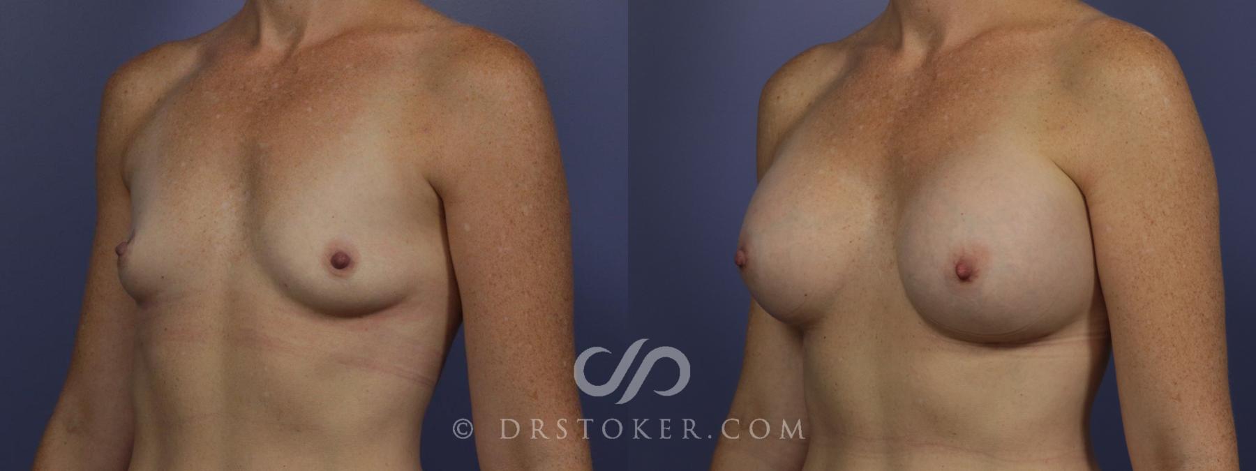 Before & After Breast Augmentation, Rapid Recovery Case 1062 View #4 View in Los Angeles, CA
