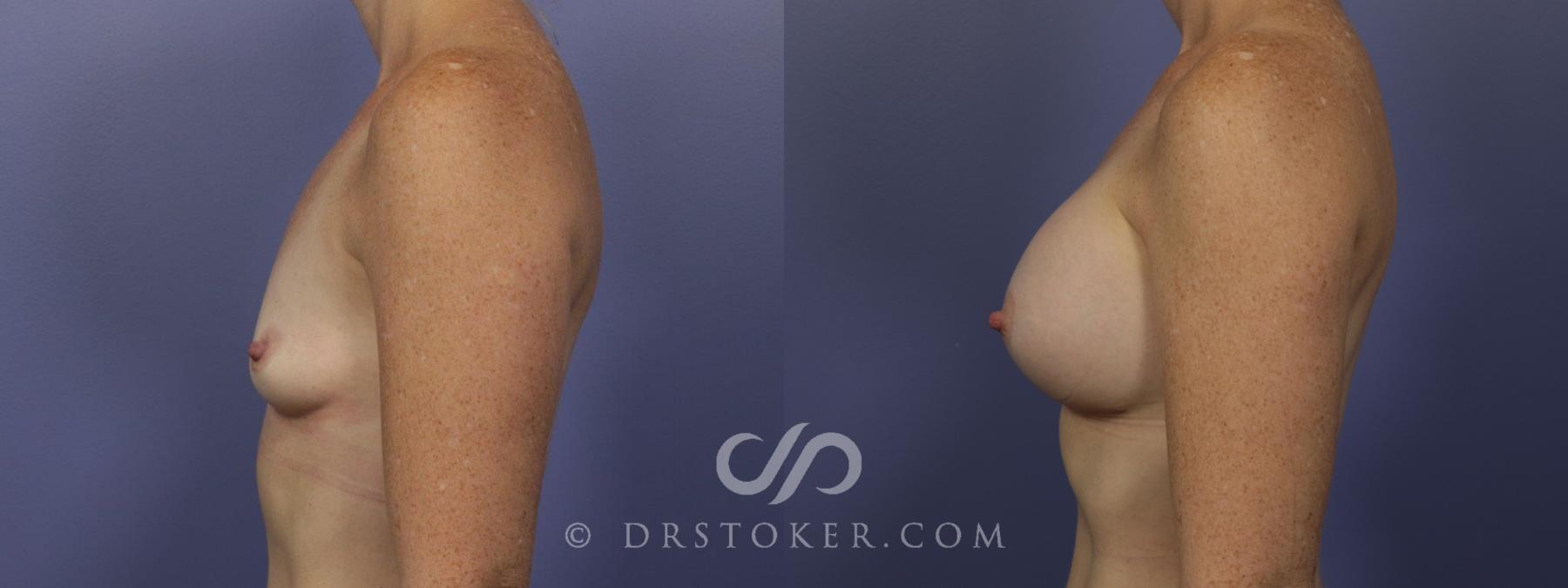 Before & After Breast Augmentation, Rapid Recovery Case 1062 View #5 View in Los Angeles, CA
