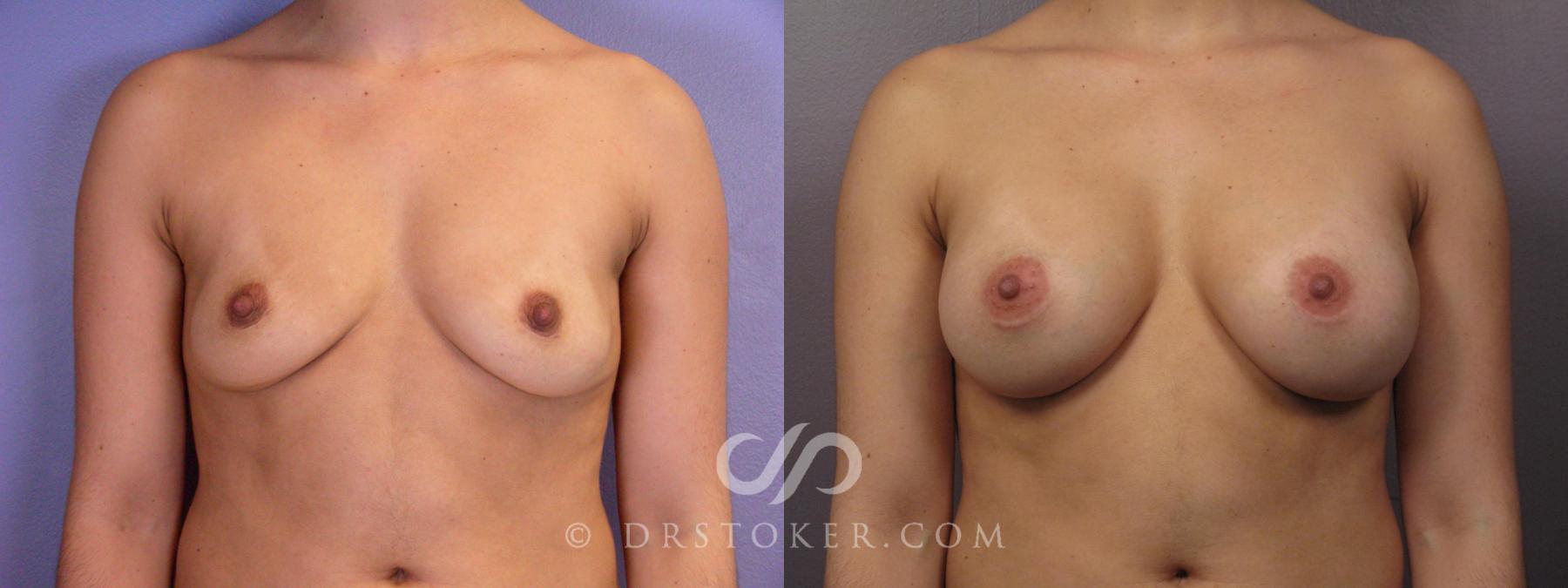 Before & After Breast Augmentation, Rapid Recovery Case 1063 View #1 View in Los Angeles, CA