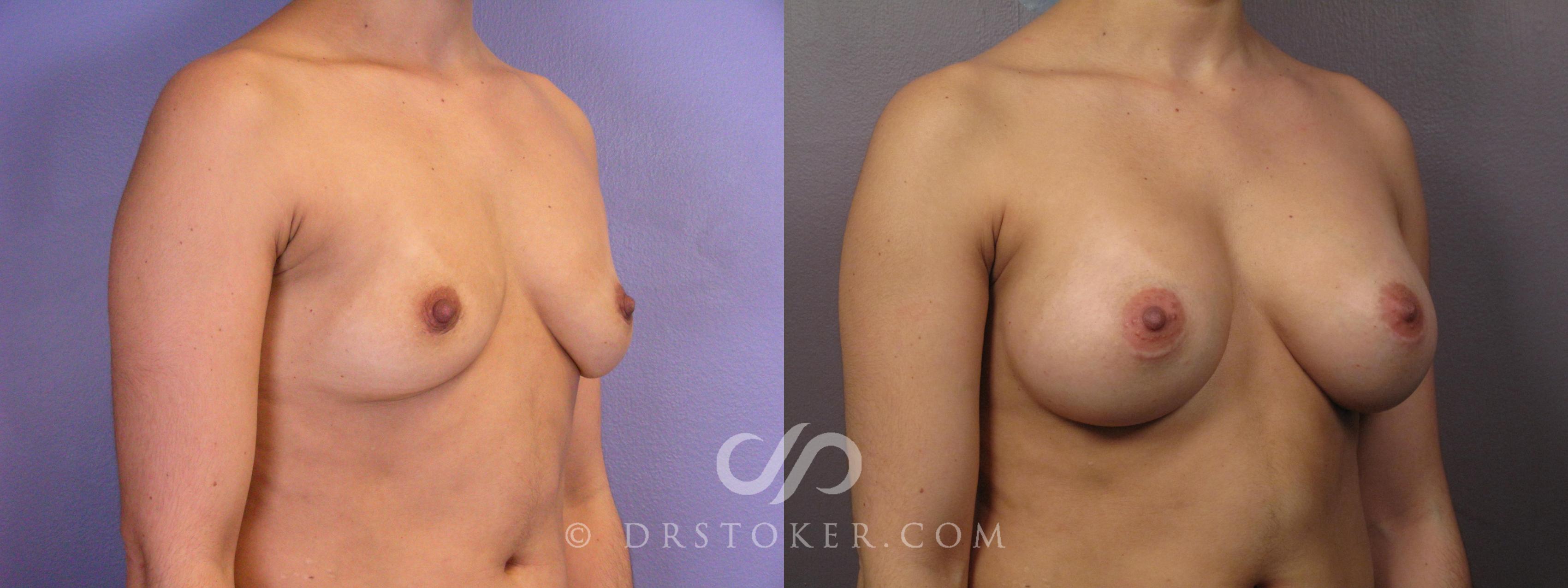 Before & After Breast Augmentation, Rapid Recovery Case 1063 View #2 View in Los Angeles, CA