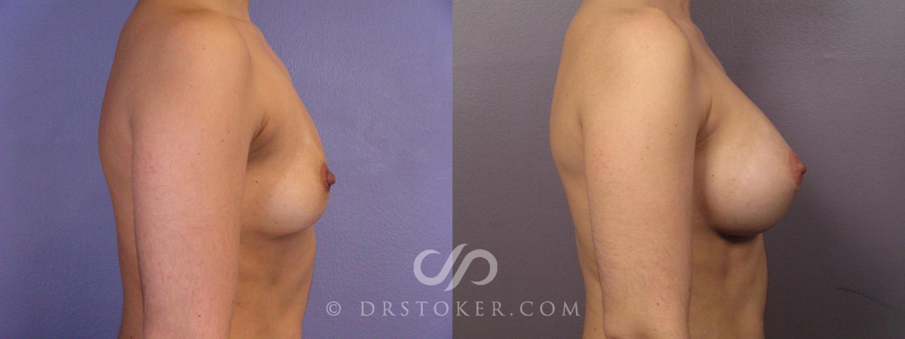 Before & After Breast Augmentation, Rapid Recovery Case 1063 View #3 View in Los Angeles, CA