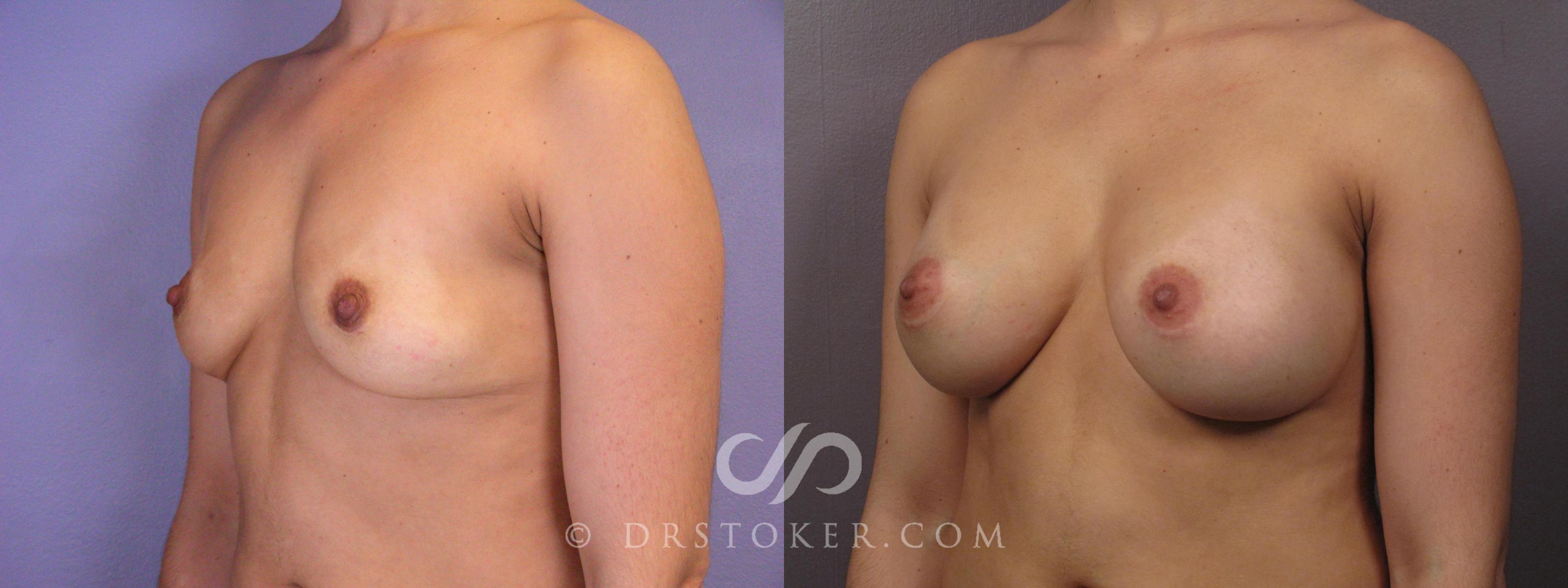 Before & After Breast Augmentation, Rapid Recovery Case 1063 View #4 View in Los Angeles, CA