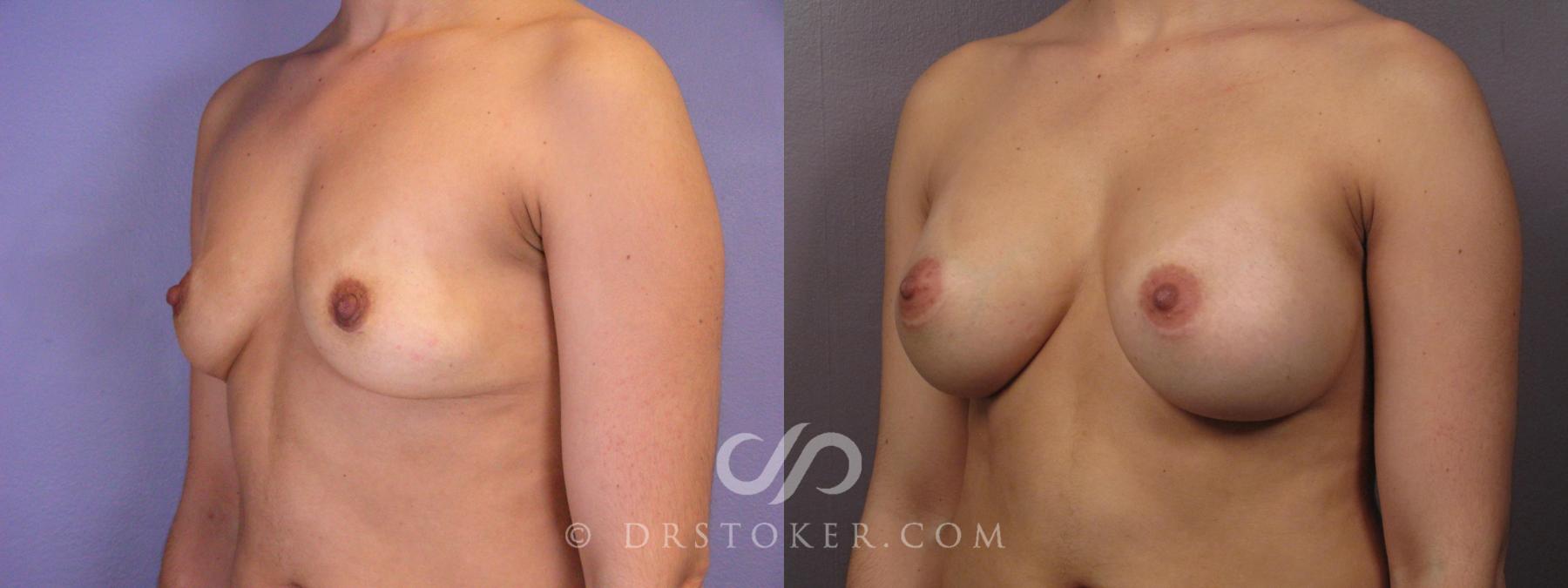 Before & After Breast Augmentation, Rapid Recovery Case 1063 View #4 View in Los Angeles, CA