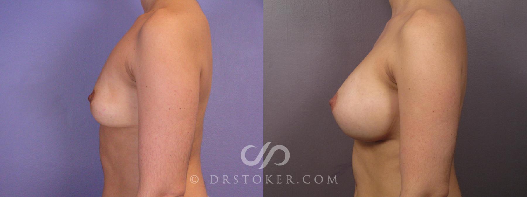 Before & After Breast Augmentation, Rapid Recovery Case 1063 View #5 View in Los Angeles, CA