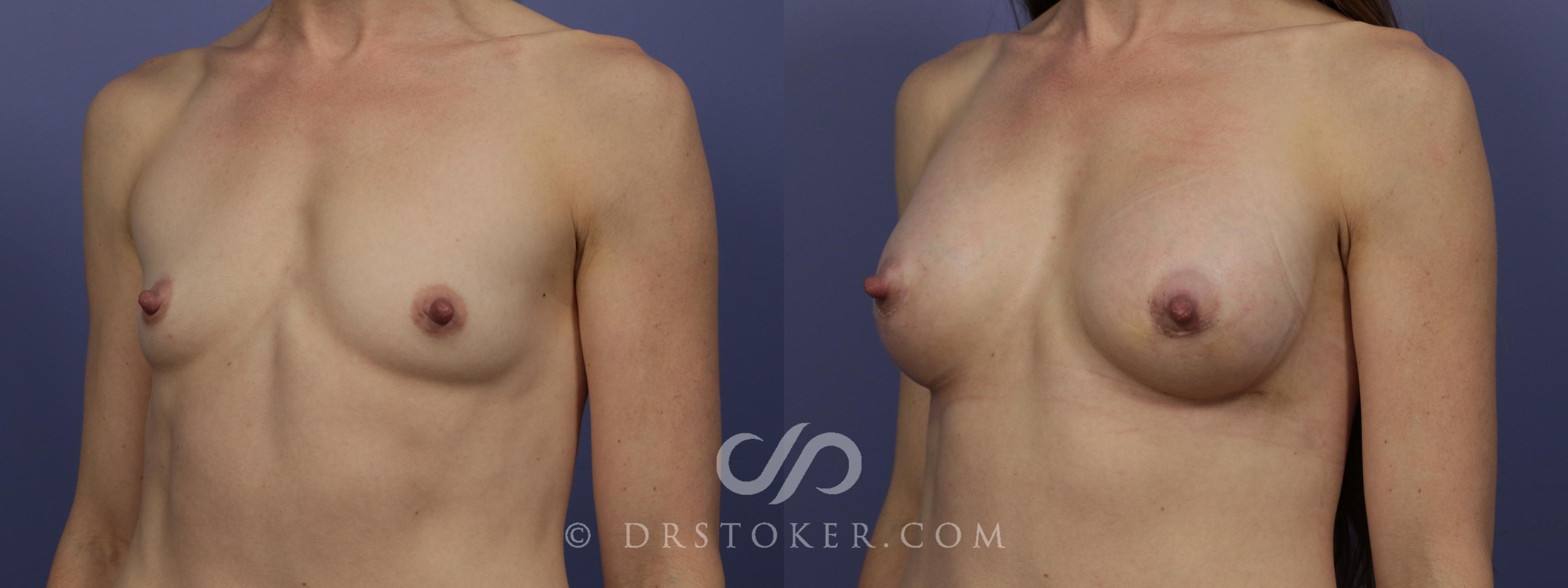 Before & After Breast Augmentation, Rapid Recovery Case 1064 View #4 View in Los Angeles, CA