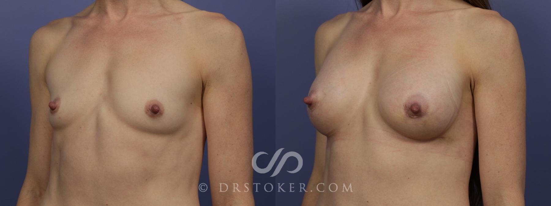 Before & After Breast Augmentation, Rapid Recovery Case 1064 View #4 View in Los Angeles, CA