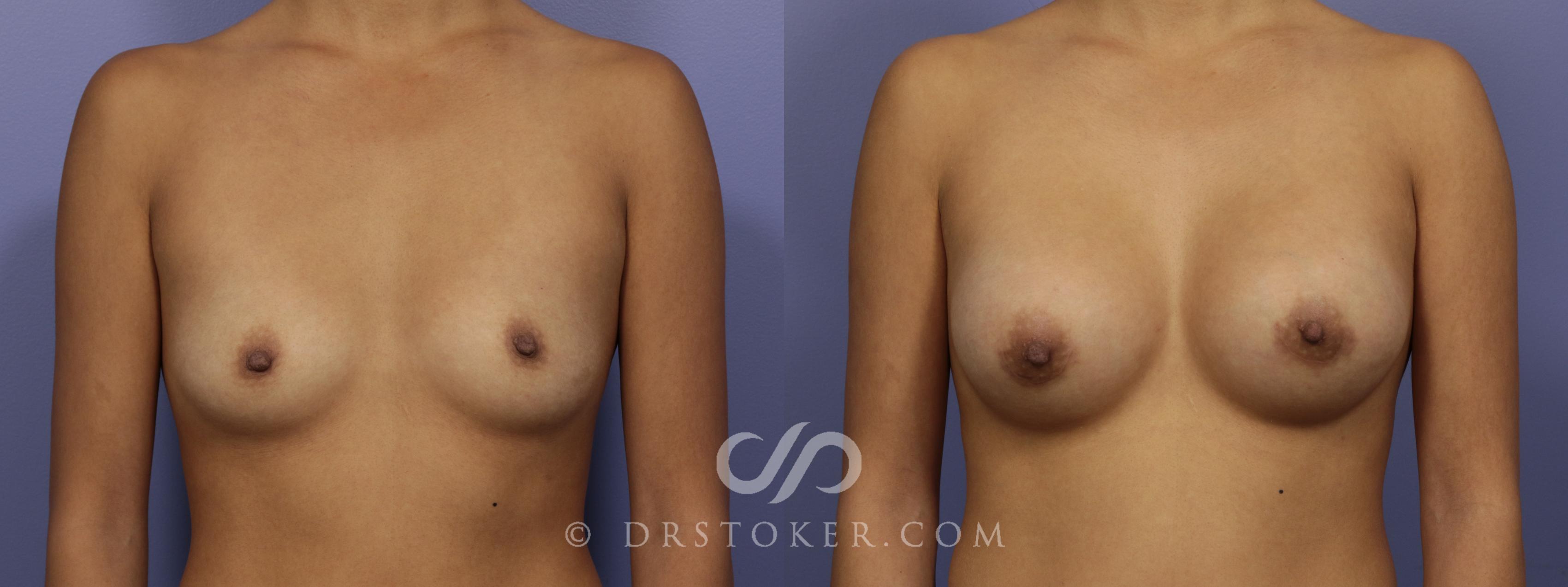 Before & After Breast Augmentation, Rapid Recovery Case 1066 View #1 View in Los Angeles, CA