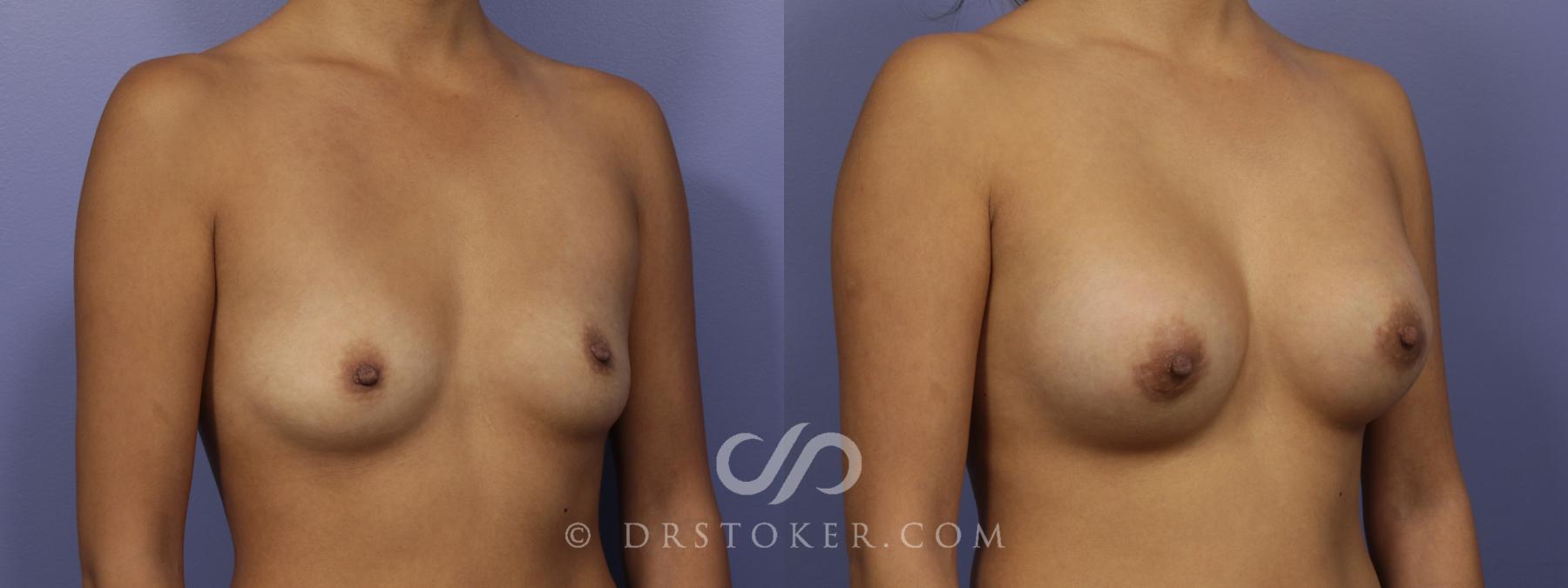 Before & After Breast Augmentation, Rapid Recovery Case 1066 View #2 View in Los Angeles, CA