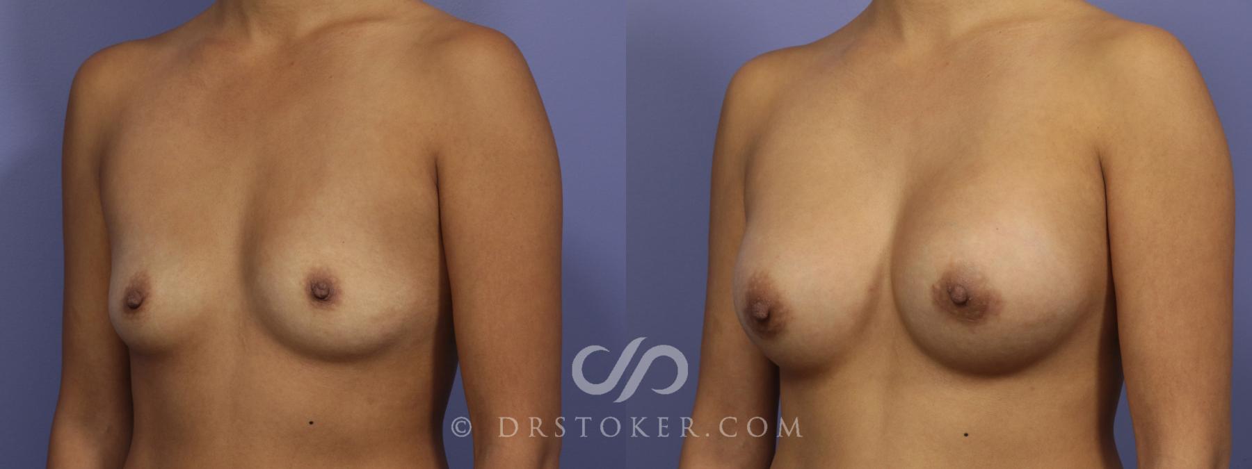 Before & After Breast Augmentation, Rapid Recovery Case 1066 View #3 View in Los Angeles, CA
