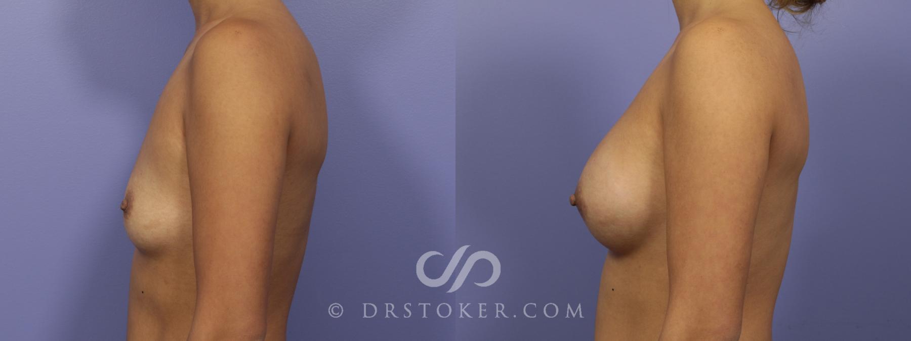 Before & After Breast Augmentation, Rapid Recovery Case 1066 View #4 View in Los Angeles, CA