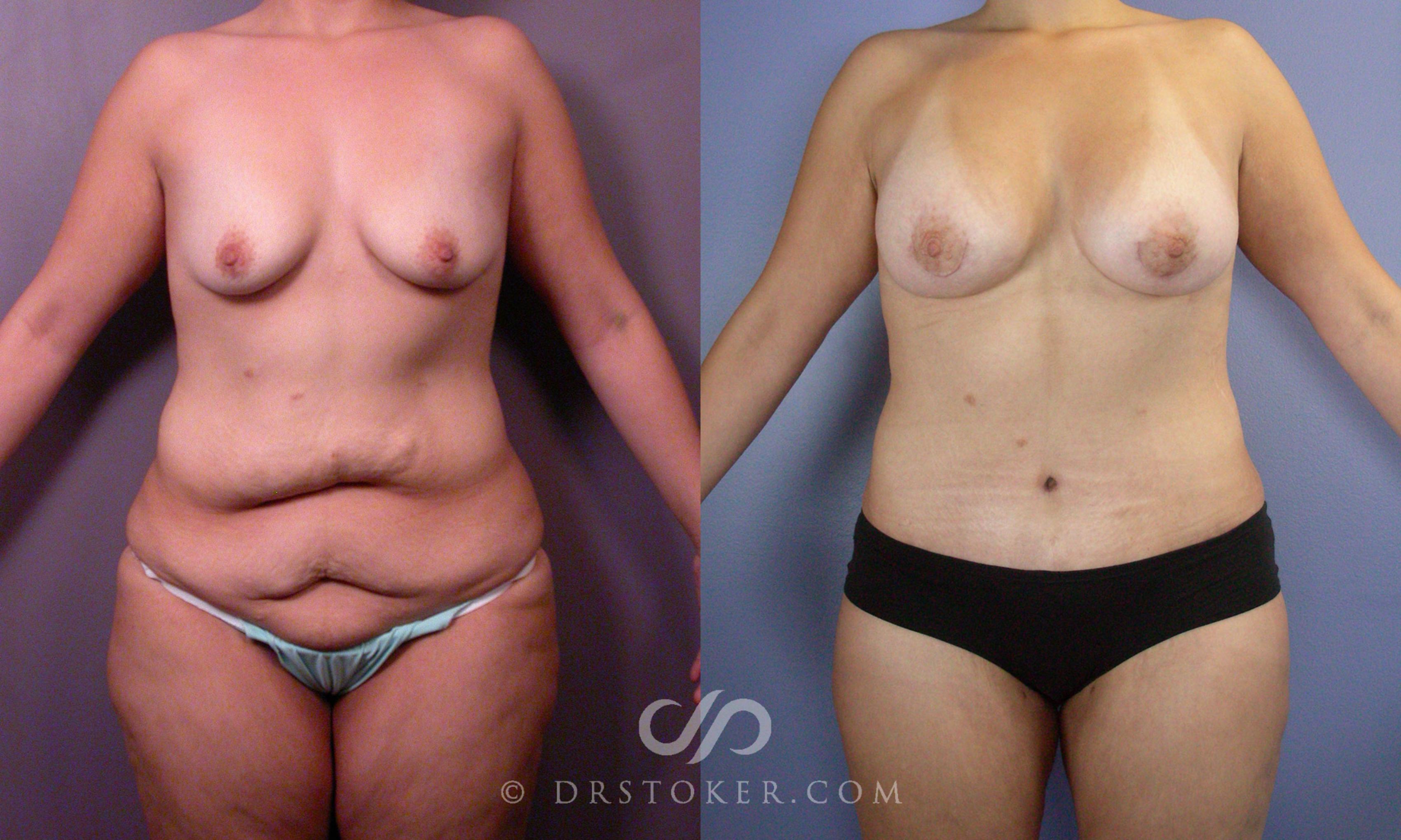 Before & After After Weight Loss Case 107 View #1 View in Los Angeles, CA
