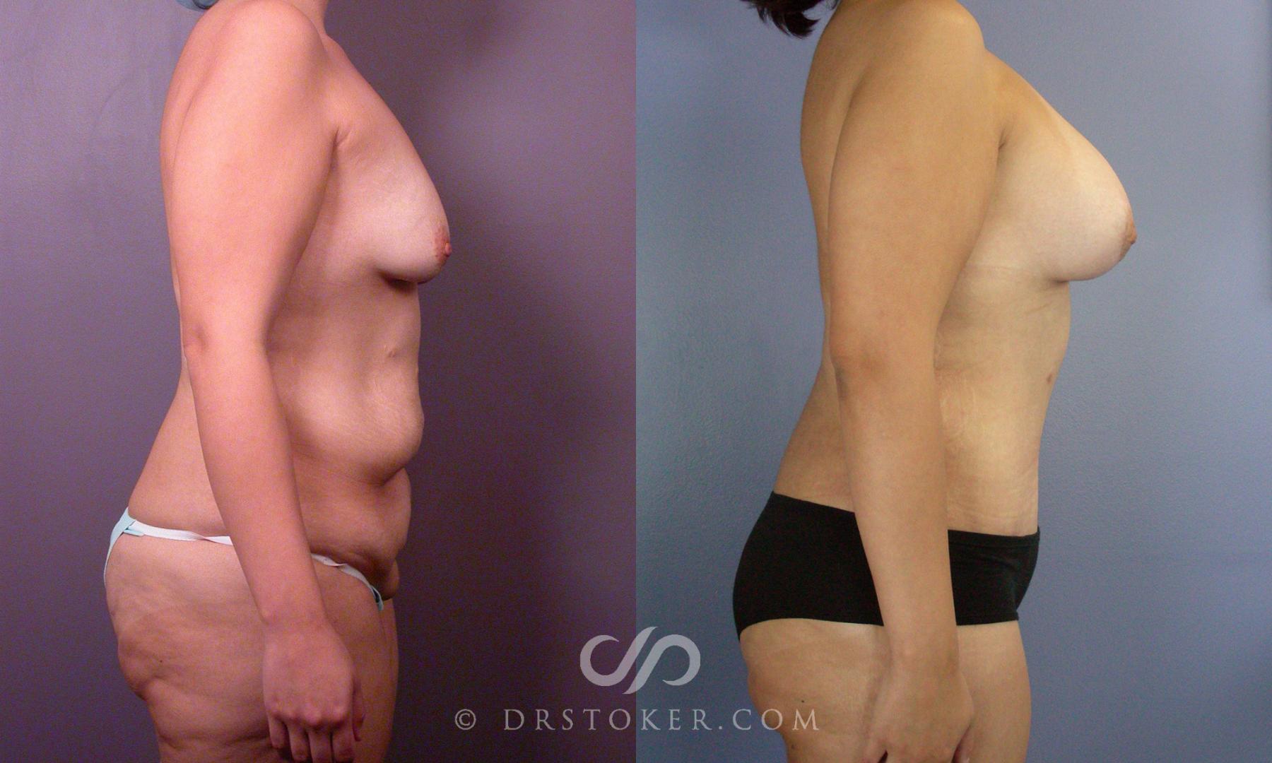 Before & After After Weight Loss Case 107 View #2 View in Los Angeles, CA