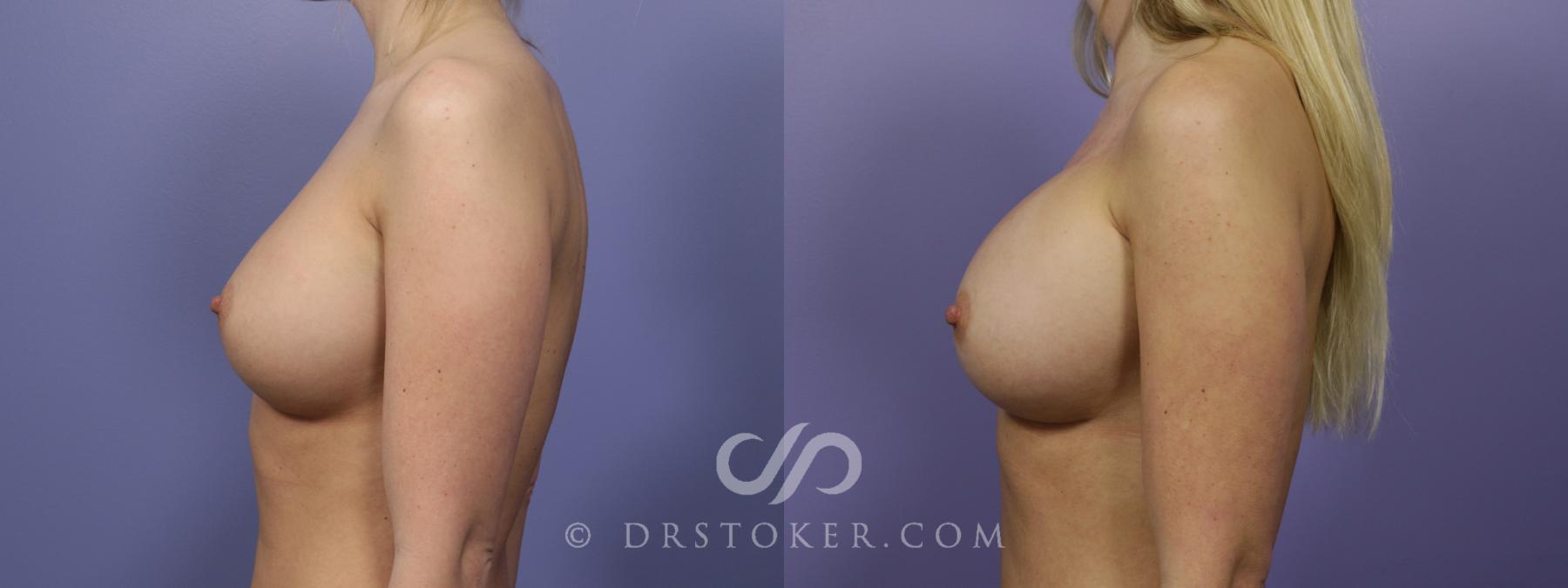 Before & After Breast Augmentation, Rapid Recovery Case 1270 View #5 View in Los Angeles, CA
