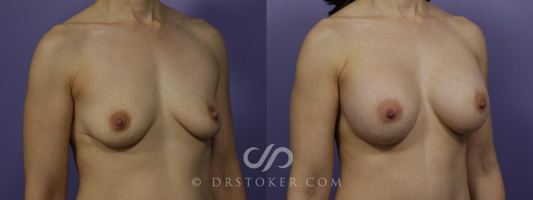 Before & After Breast Augmentation, Rapid Recovery Case 1272 View #2 View in Los Angeles, CA