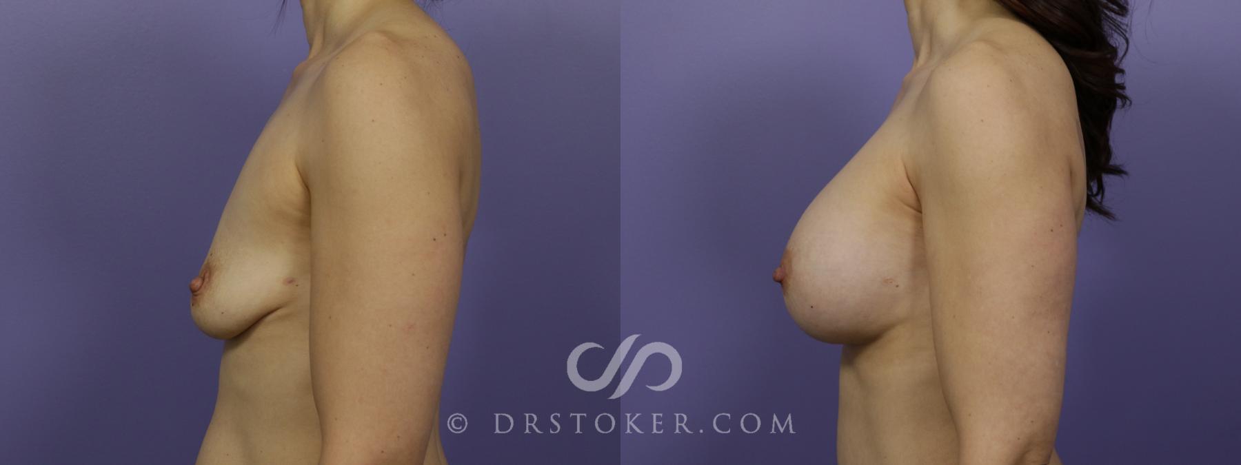 Before & After Breast Augmentation, Rapid Recovery Case 1272 View #5 View in Los Angeles, CA