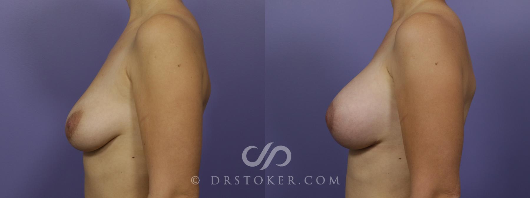 Before & After Breast Lift Case 1274 View #4 View in Los Angeles, CA