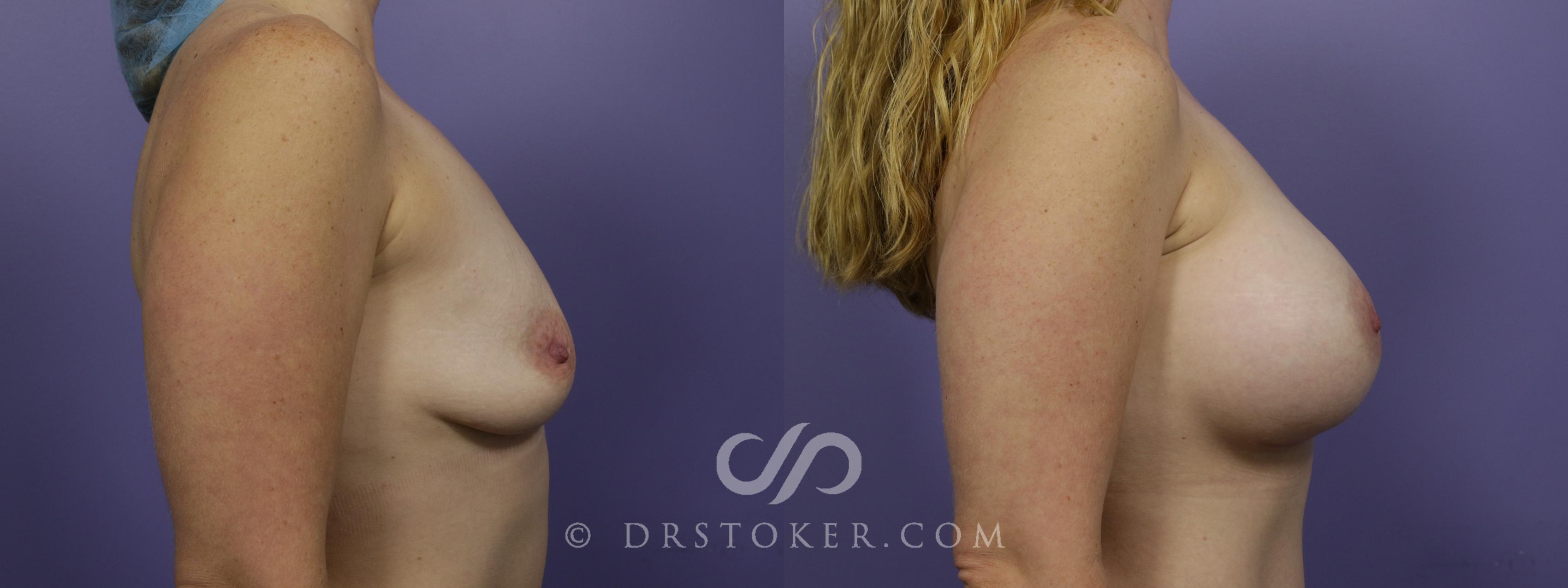 Before & After Breast Augmentation, Rapid Recovery Case 1366 View #3 View in Los Angeles, CA