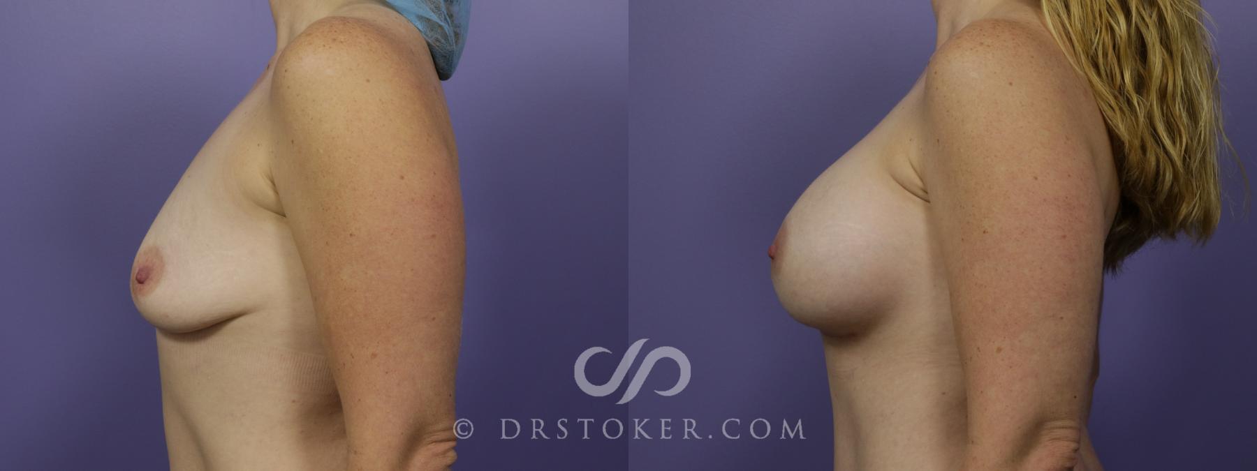 Before & After Breast Augmentation, Rapid Recovery Case 1366 View #5 View in Los Angeles, CA