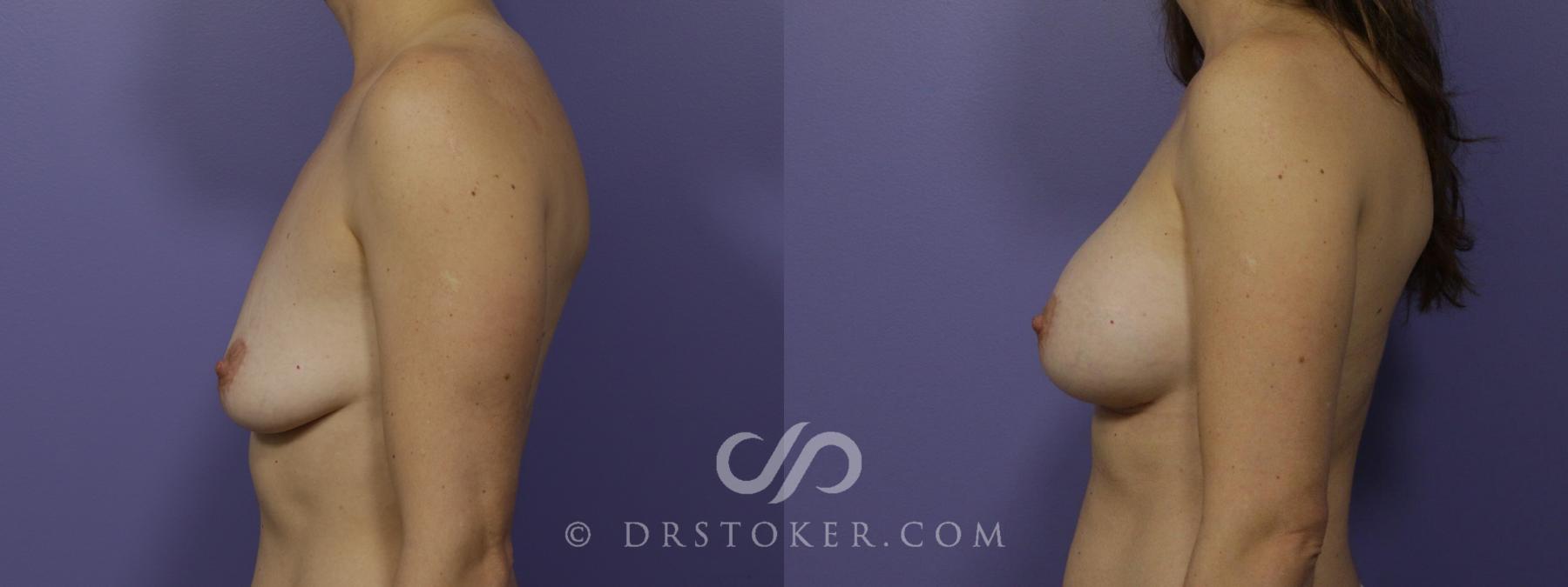 Before & After Breast Augmentation, Rapid Recovery Case 1404 View #5 View in Los Angeles, CA