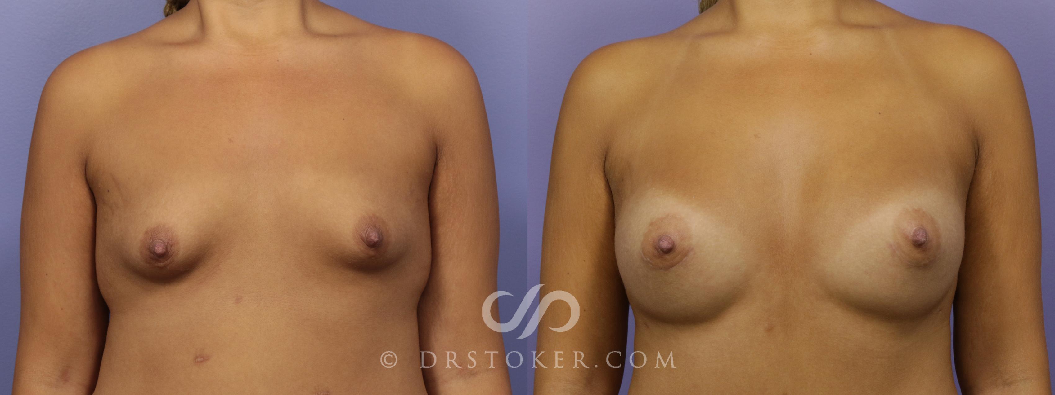 Before & After Breast Augmentation, Rapid Recovery Case 1405 View #1 View in Los Angeles, CA