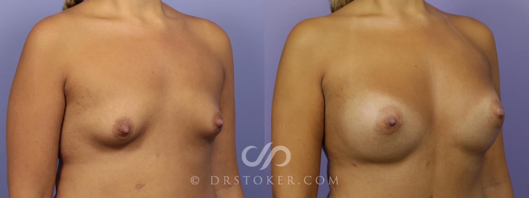 Before & After Breast Augmentation, Rapid Recovery Case 1405 View #2 View in Los Angeles, CA