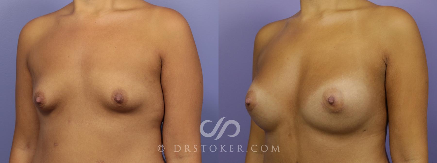 Before & After Breast Augmentation, Rapid Recovery Case 1405 View #3 View in Los Angeles, CA