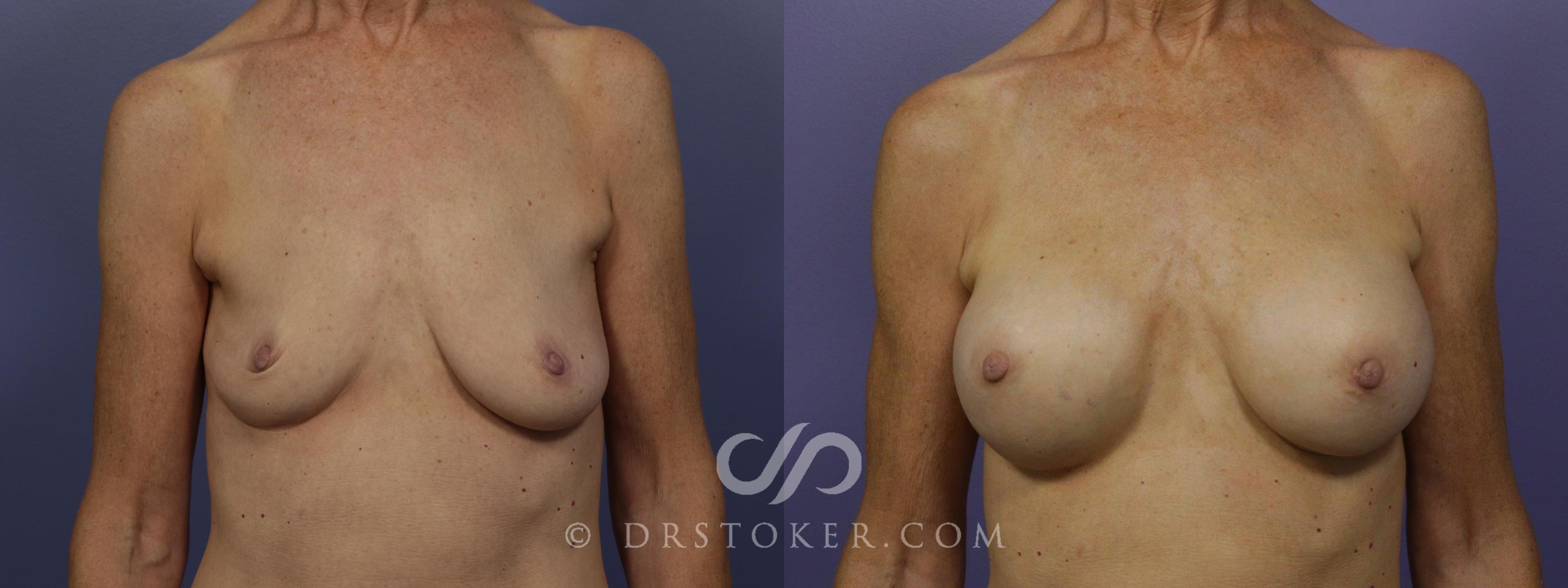 Before & After Breast Augmentation, Rapid Recovery Case 1406 View #1 View in Los Angeles, CA