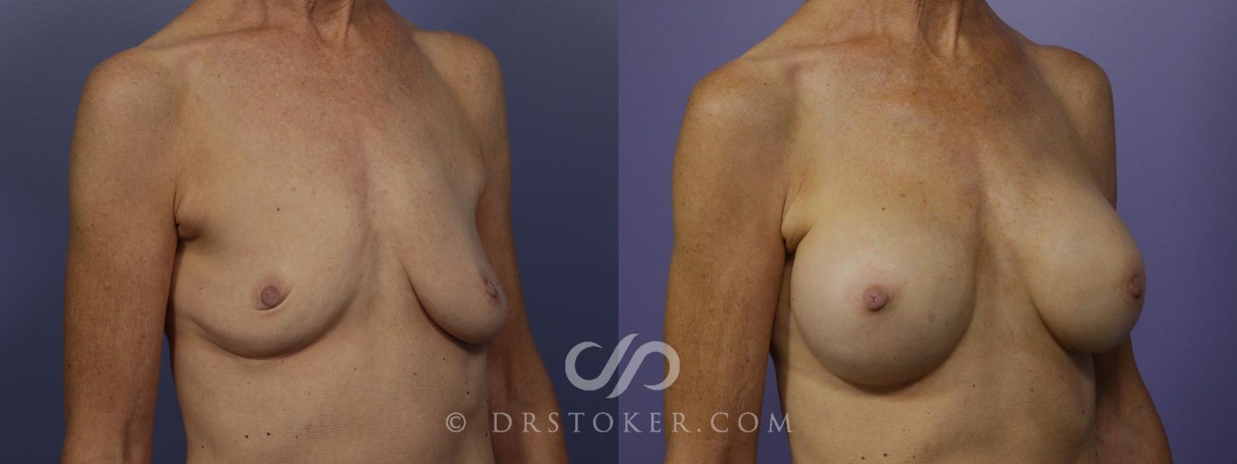 Before & After Breast Augmentation, Rapid Recovery Case 1406 View #2 View in Los Angeles, CA