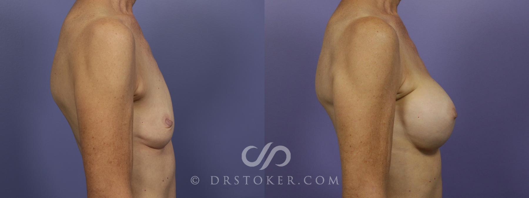 Before & After Breast Augmentation, Rapid Recovery Case 1406 View #3 View in Los Angeles, CA