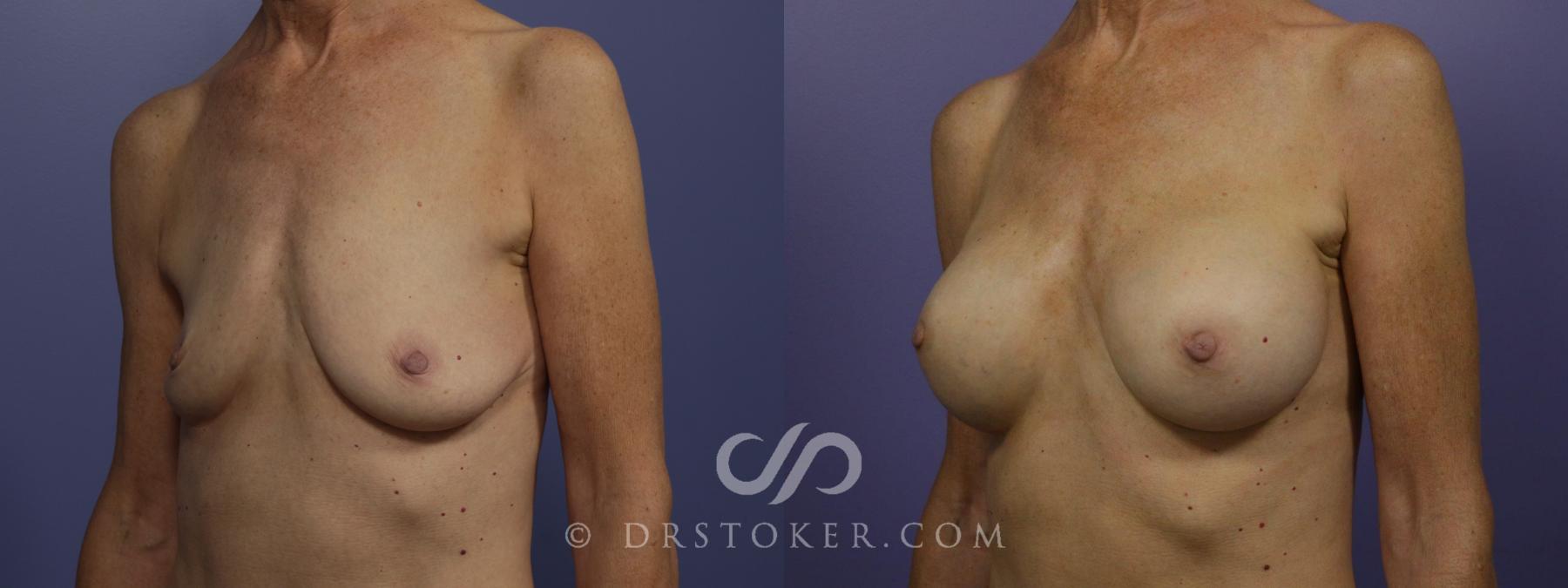 Before & After Breast Augmentation, Rapid Recovery Case 1406 View #4 View in Los Angeles, CA