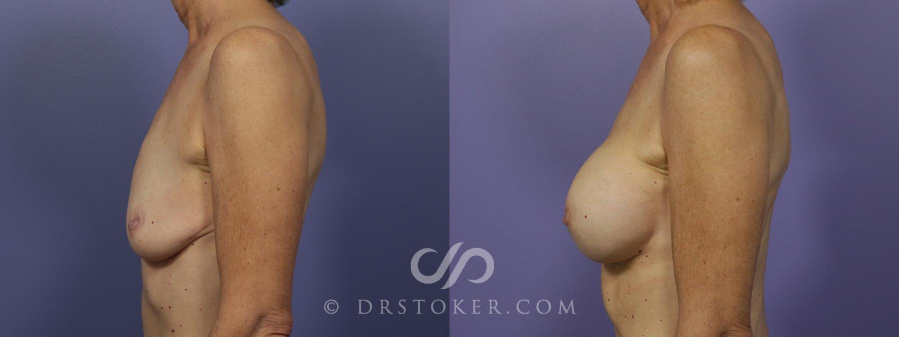 Before & After Breast Augmentation, Rapid Recovery Case 1406 View #5 View in Los Angeles, CA