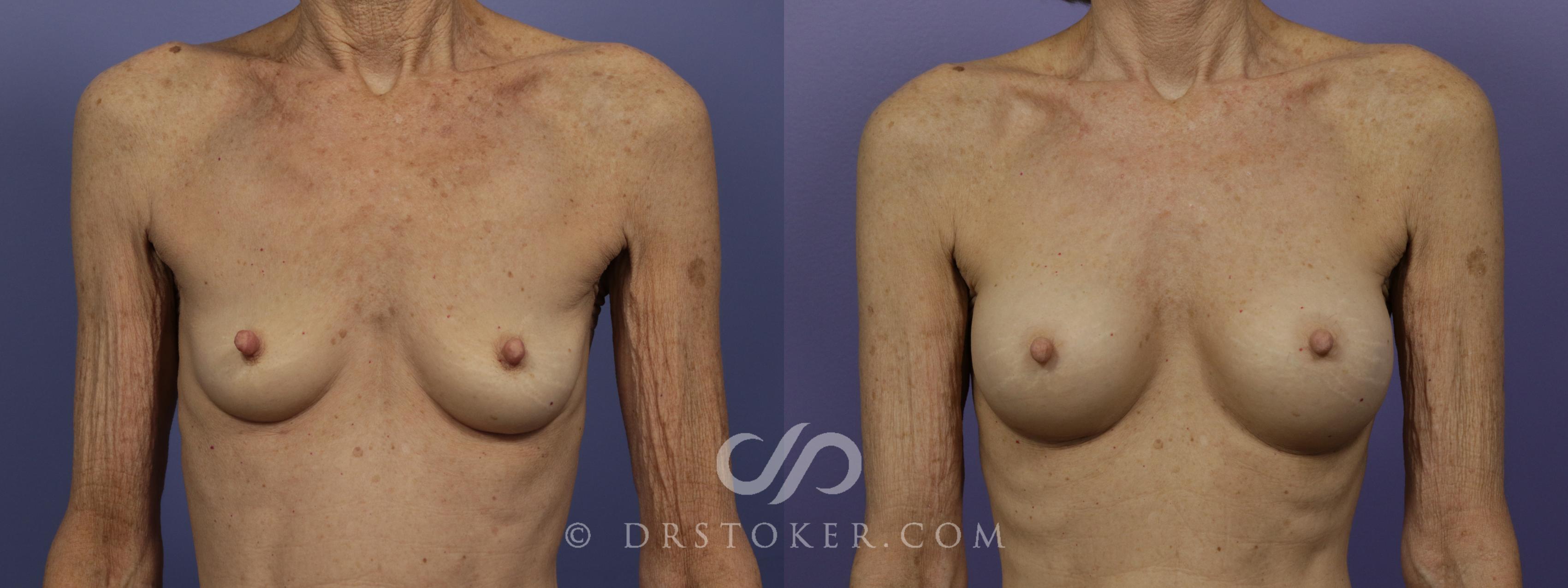 Before & After Breast Augmentation, Rapid Recovery Case 1407 View #1 View in Los Angeles, CA