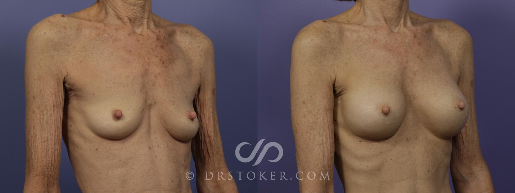 Before & After Breast Augmentation, Rapid Recovery Case 1407 View #2 View in Los Angeles, CA