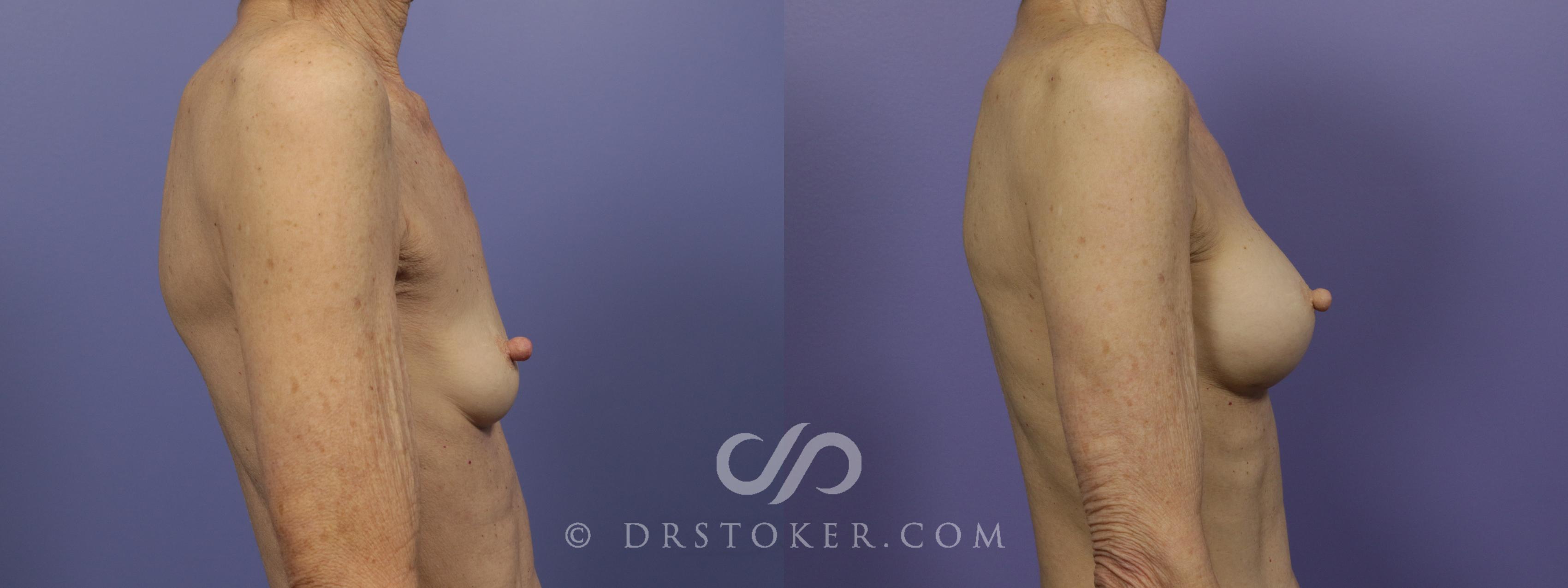 Before & After Breast Augmentation, Rapid Recovery Case 1407 View #3 View in Los Angeles, CA