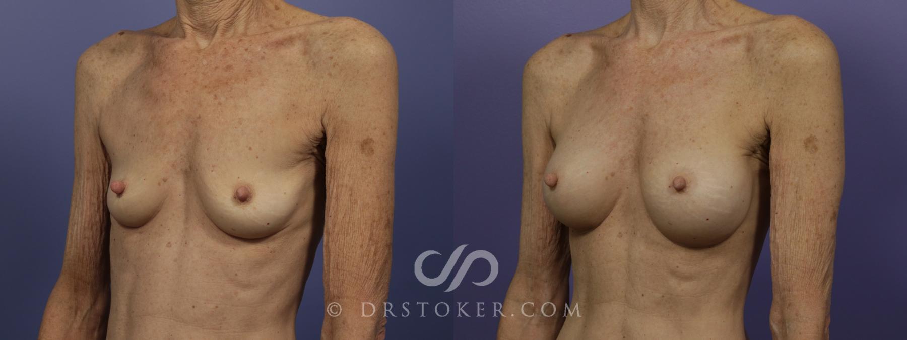 Before & After Breast Augmentation, Rapid Recovery Case 1407 View #4 View in Los Angeles, CA