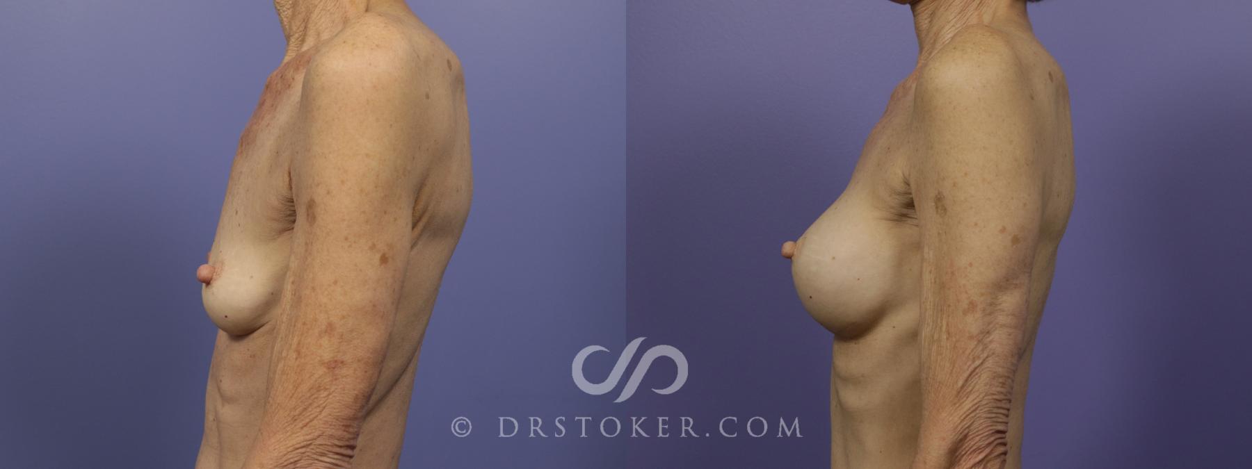 Before & After Breast Augmentation, Rapid Recovery Case 1407 View #5 View in Los Angeles, CA