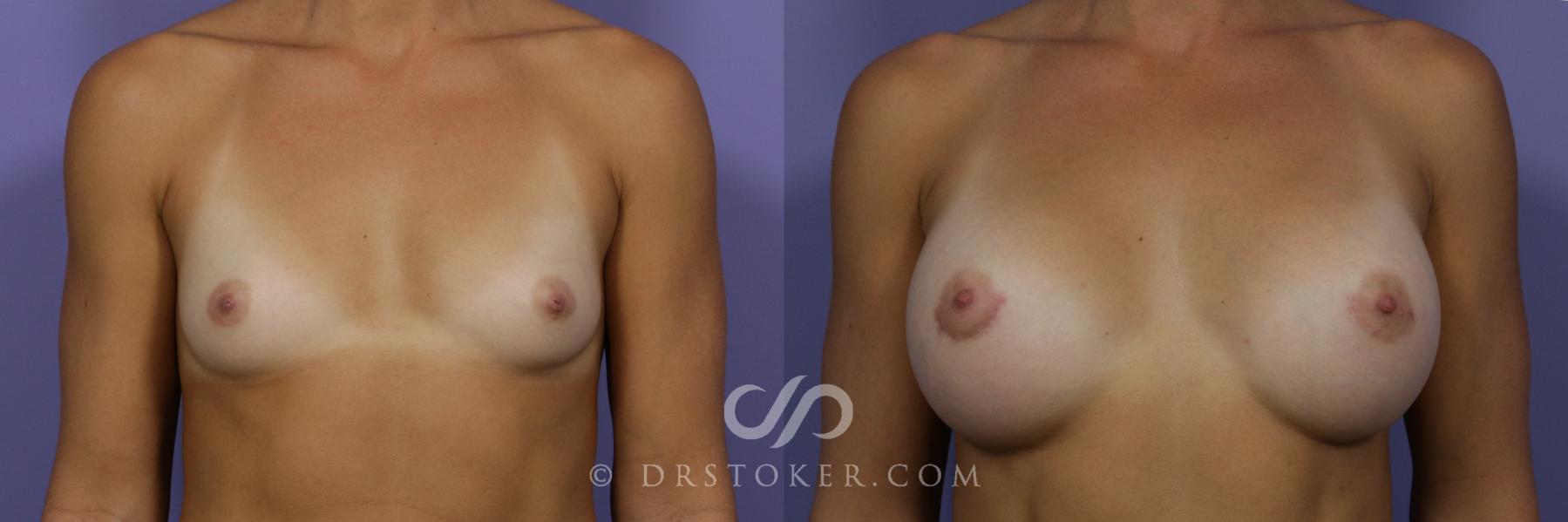 Before & After Breast Augmentation, Rapid Recovery Case 1409 View #1 View in Los Angeles, CA
