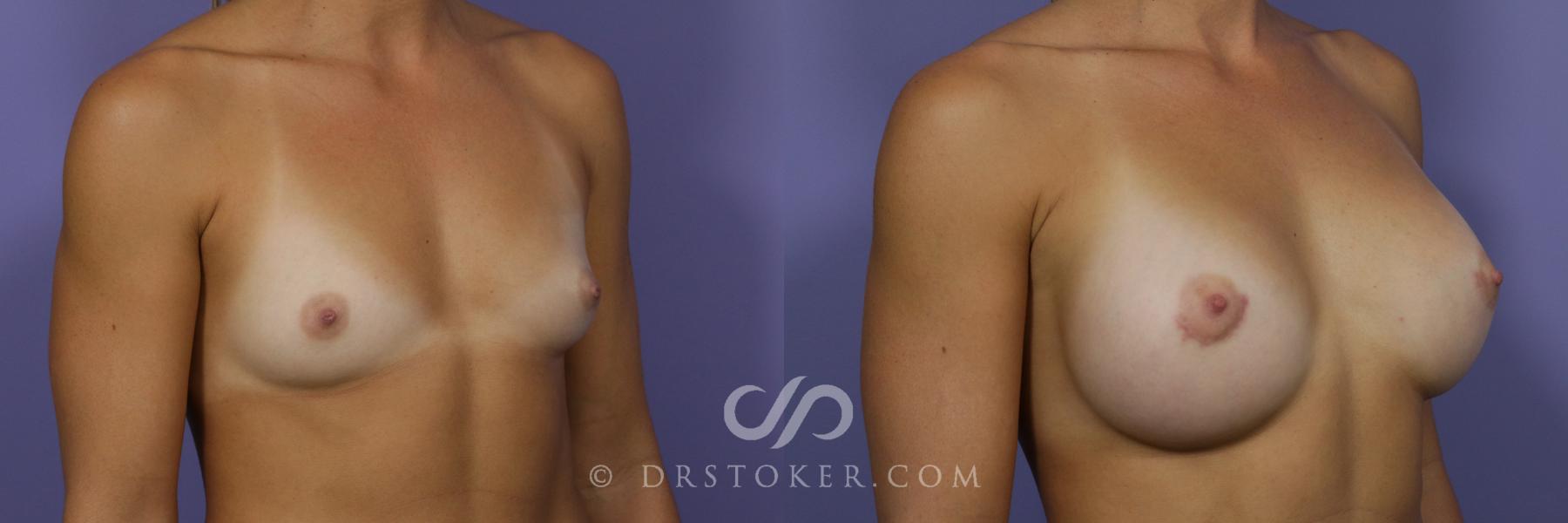 Before & After Breast Augmentation, Rapid Recovery Case 1409 View #2 View in Los Angeles, CA