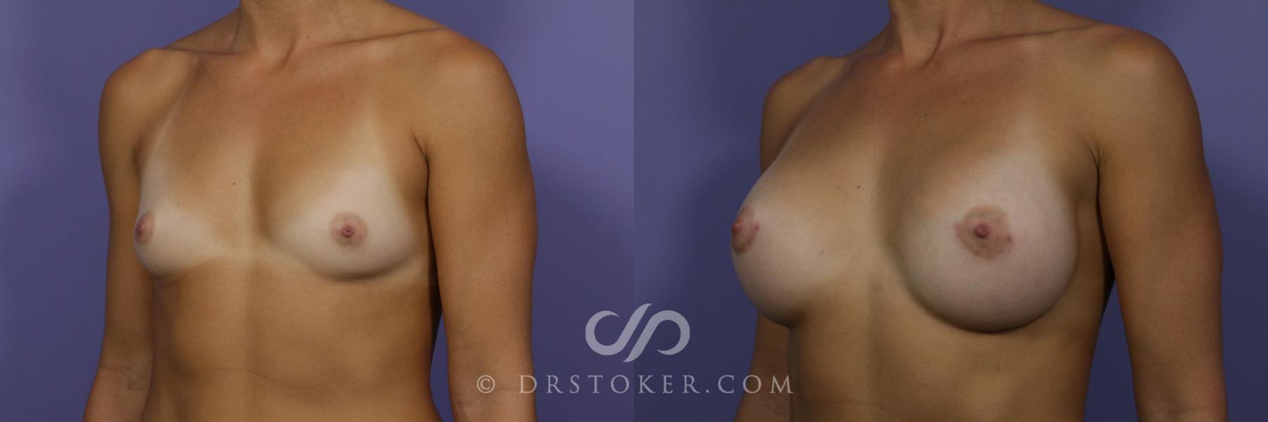 Before & After Breast Augmentation, Rapid Recovery Case 1409 View #4 View in Los Angeles, CA