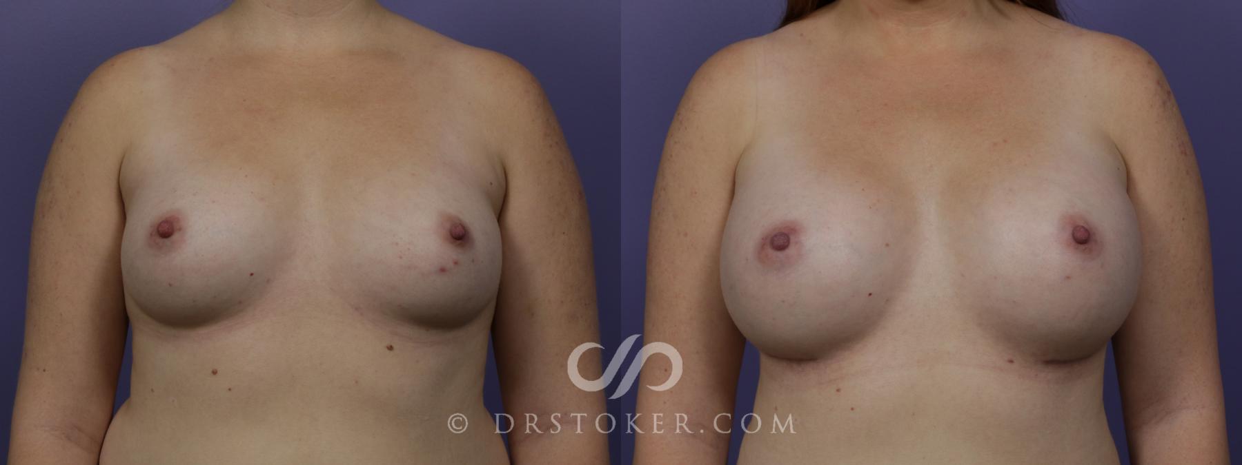 Before & After Breast Augmentation, Rapid Recovery Case 1513 View #1 View in Los Angeles, CA